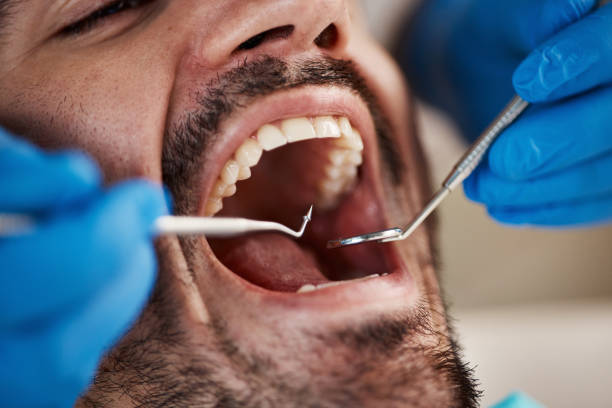 Best Emergency Dental Care for Broken or Chipped Teeth in Cannon Falls, MN